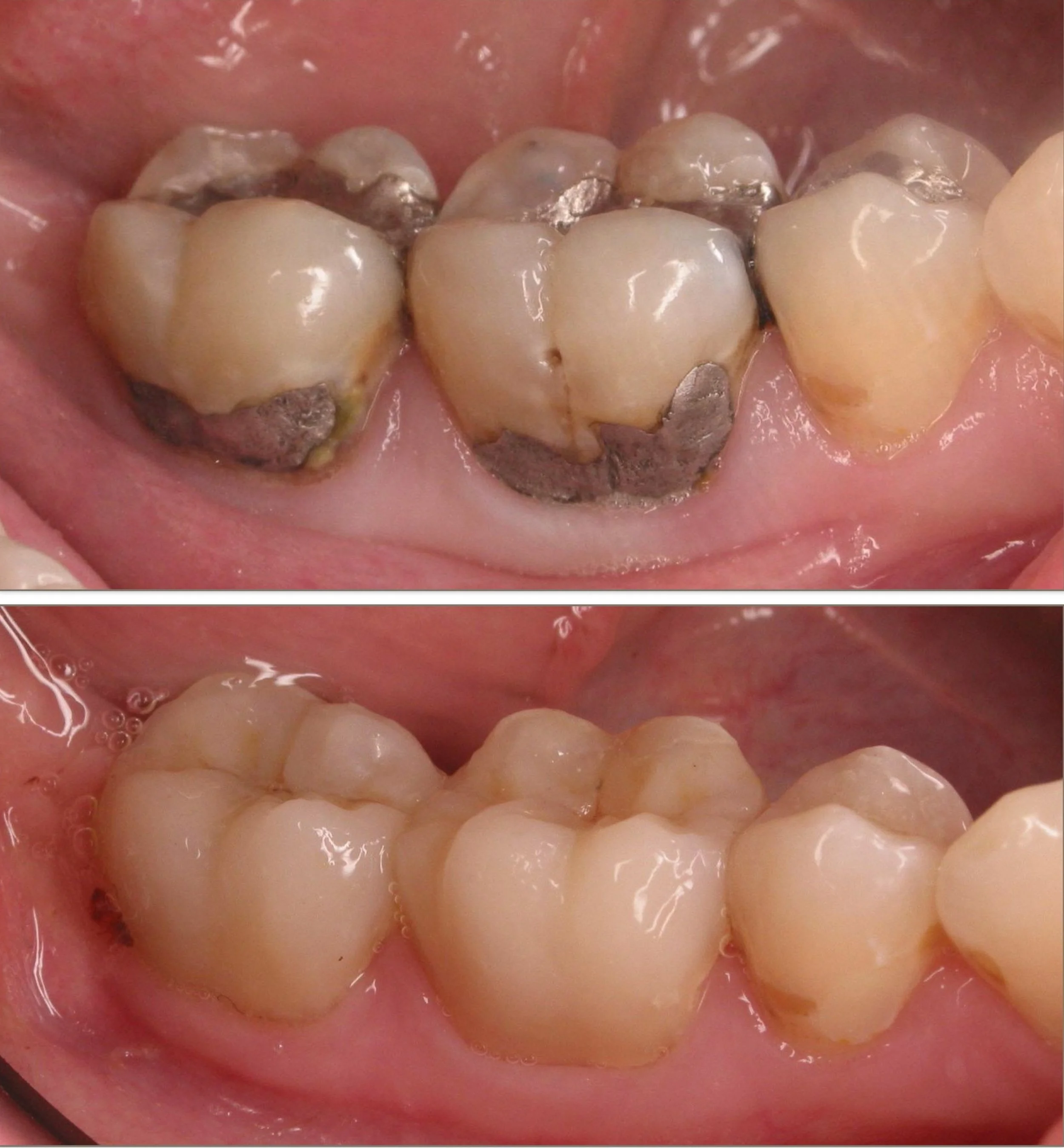 Cosmetic dentistry - porcelain onlays at ORA in Chicago