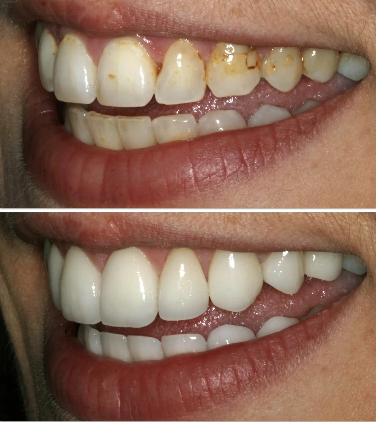 Cosmetic dentistry - Porcelain Veneers at ORA in Chicago