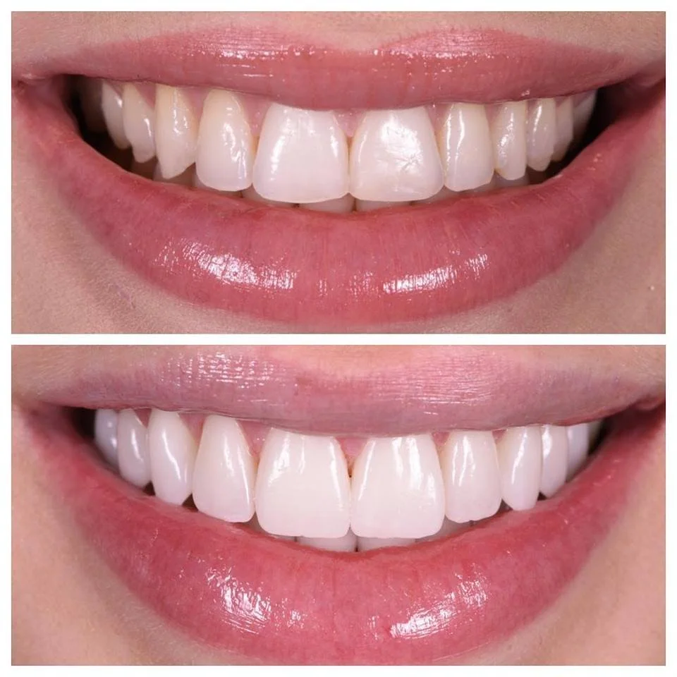 No-prep porcelain veneers at ORAesthetik