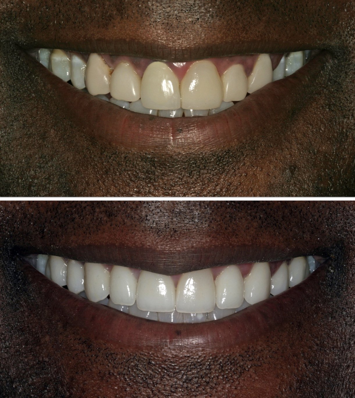 Cosmetic dentistry - Porcelain Veneers at ORA in Chicago