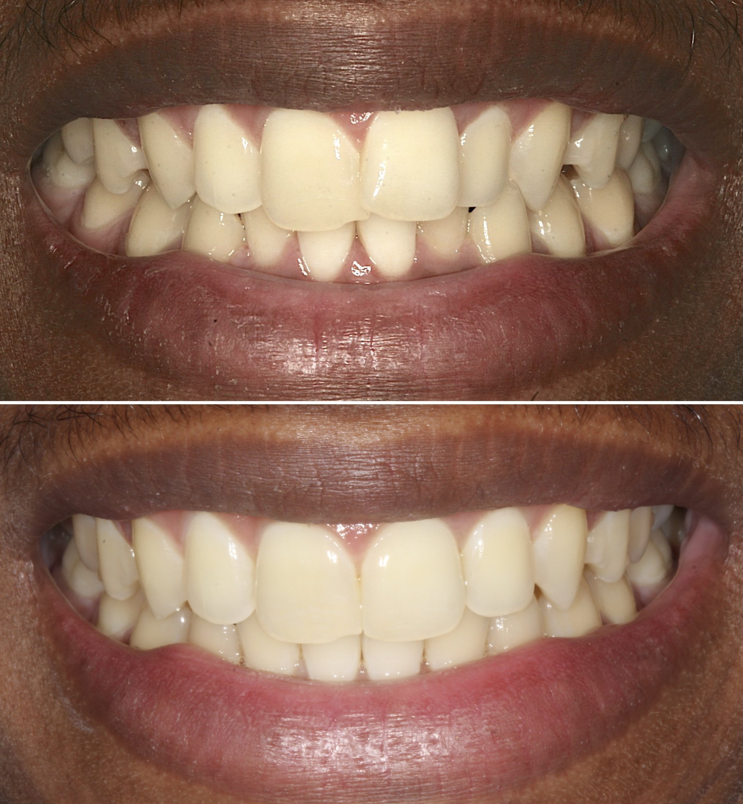 Cosmetic dentistry - Invisalign at ORA in Chicago