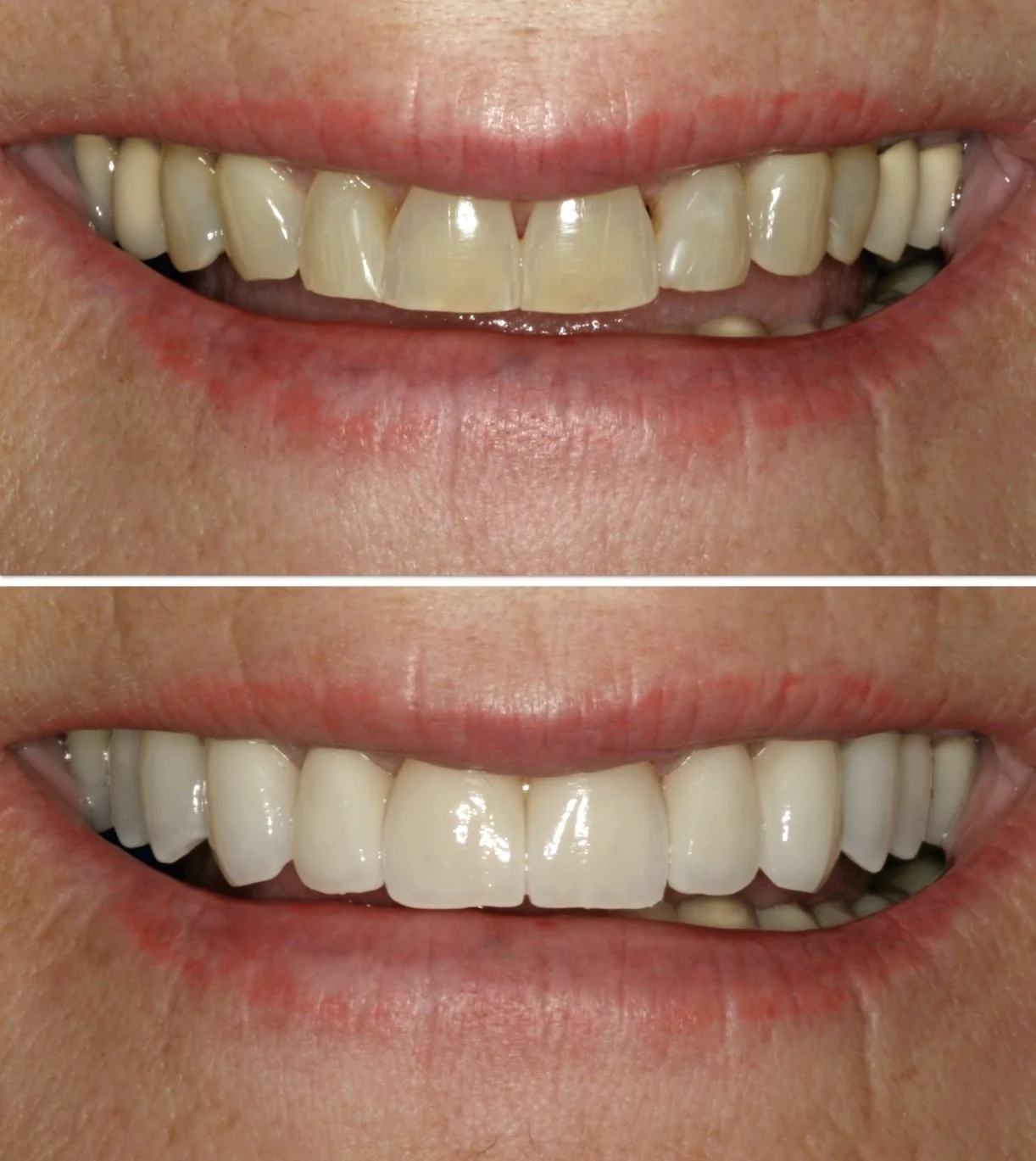 Cosmetic dentistry - 3DVNR™ No Prep 3D Printed Porcelain Veneers at ORA in Chicago