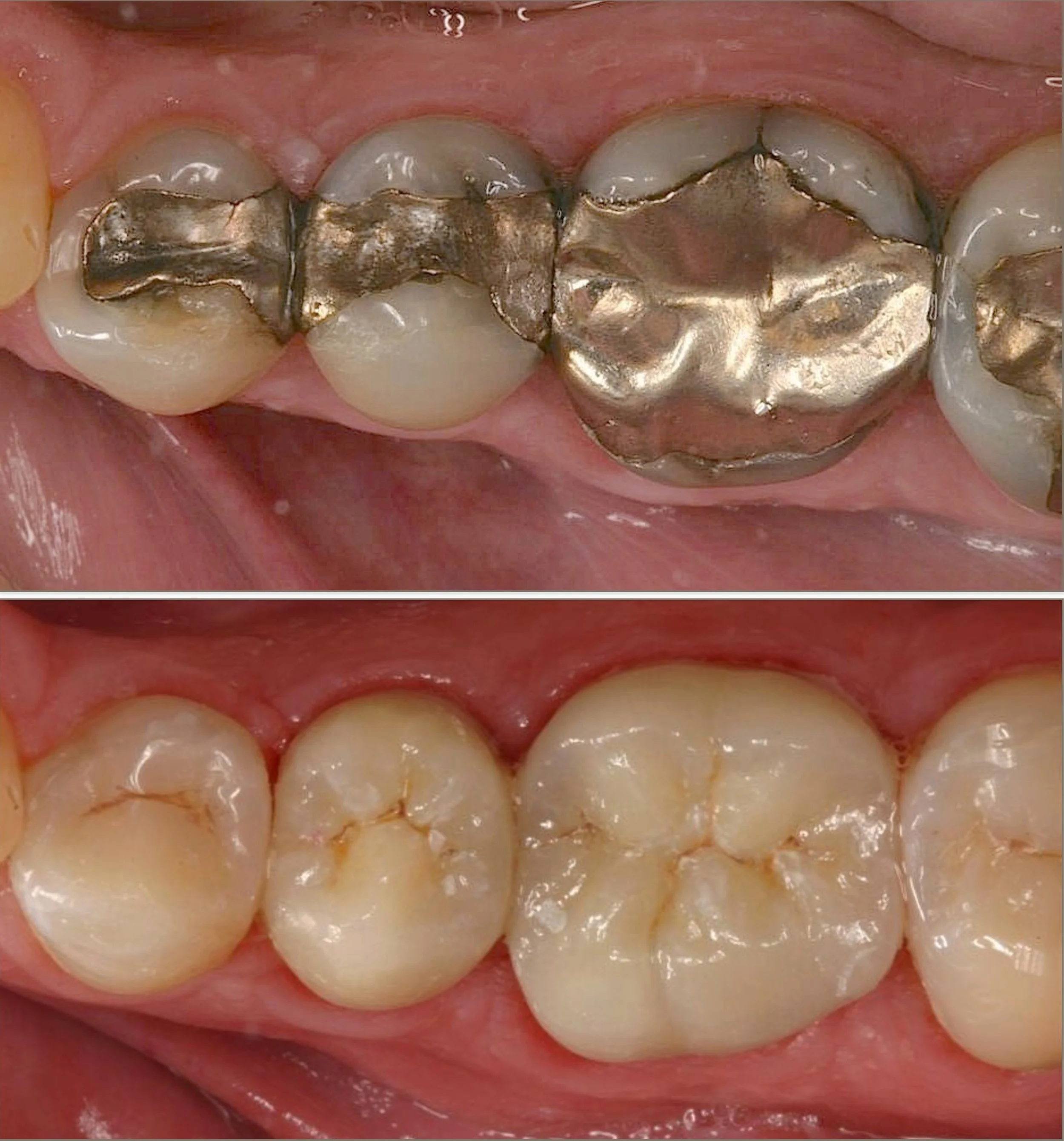 Cosmetic dentistry - Porcelain crowns at ORA in Chicago