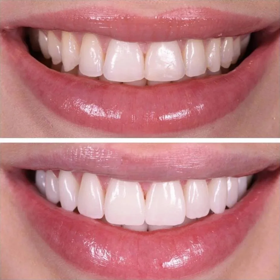 Before and after of 3DVNR 3D printed no prep porcelain veneers
