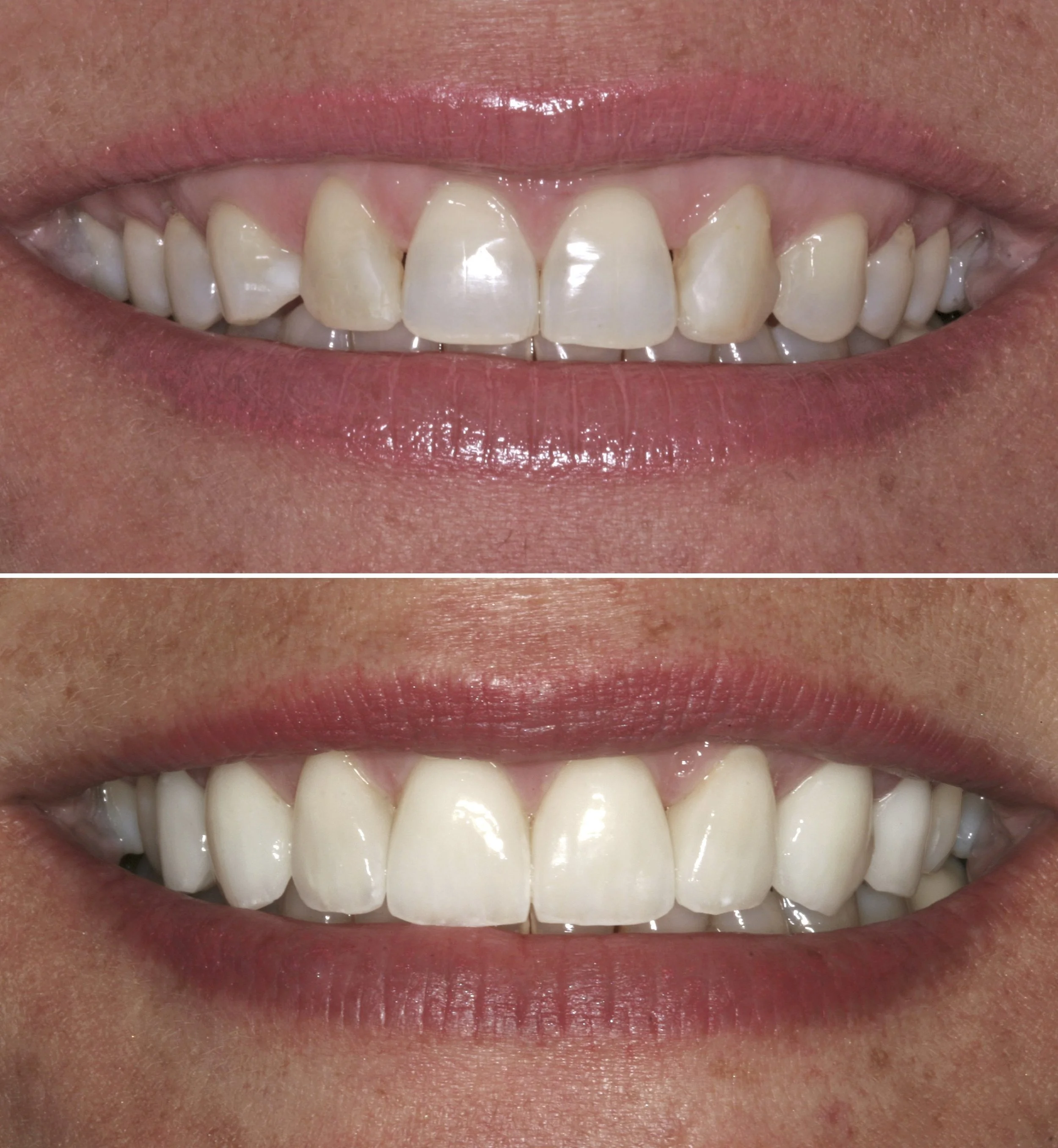 Cosmetic dentistry - Porcelain Veneers at ORA in Chicago
