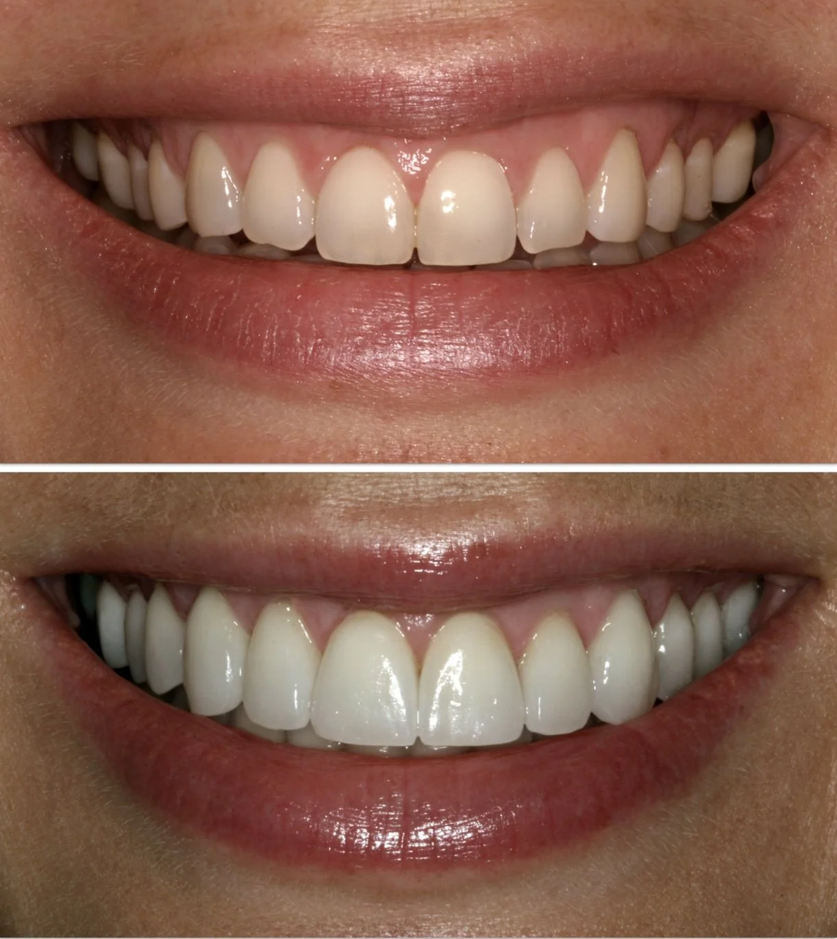 Cosmetic dentistry - Porcelain Veneers at ORA in Chicago