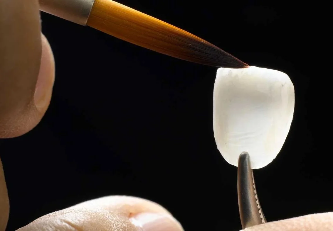 Close-up photograph of a dental veneer being precisely placed onto a tooth with a dental instrument.