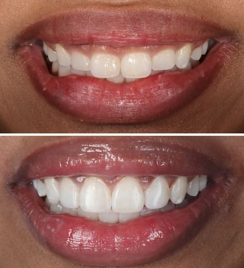 Cosmetic dentistry - Laser gim contouring at ORA in Chicago