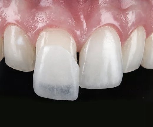 No-prep porcelain veneers at ORAesthetik