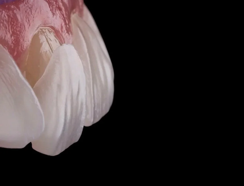 3DVNR™ no-prep porcelain veneers