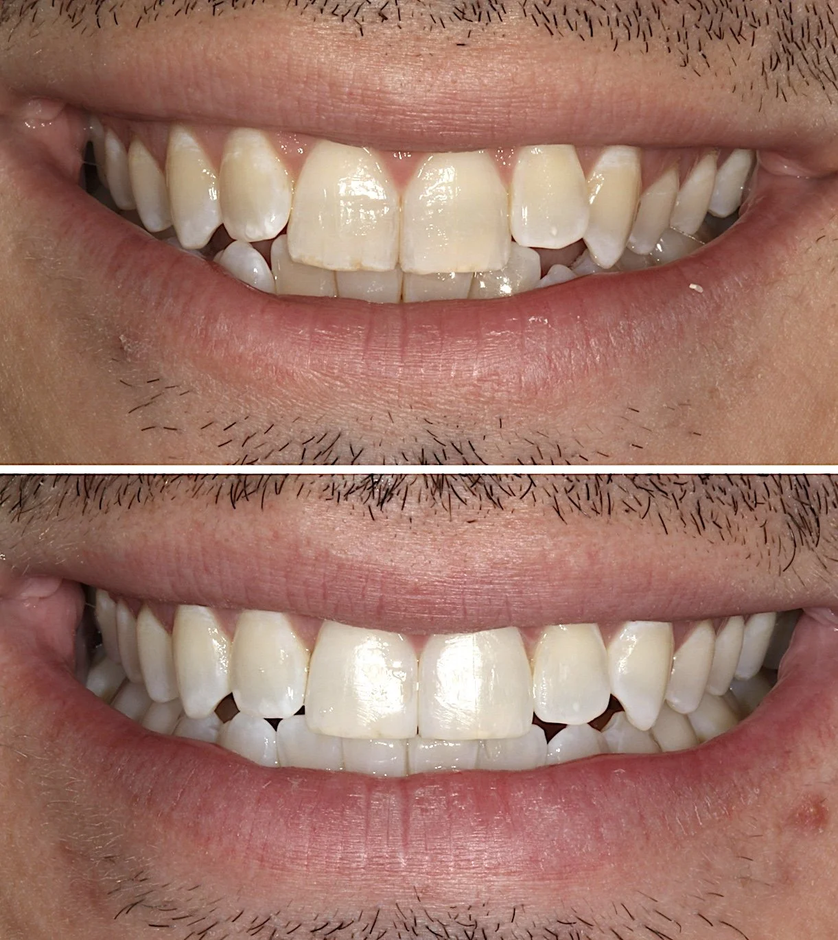 Cosmetic dentistry - Invisalign at ORA in Chicago