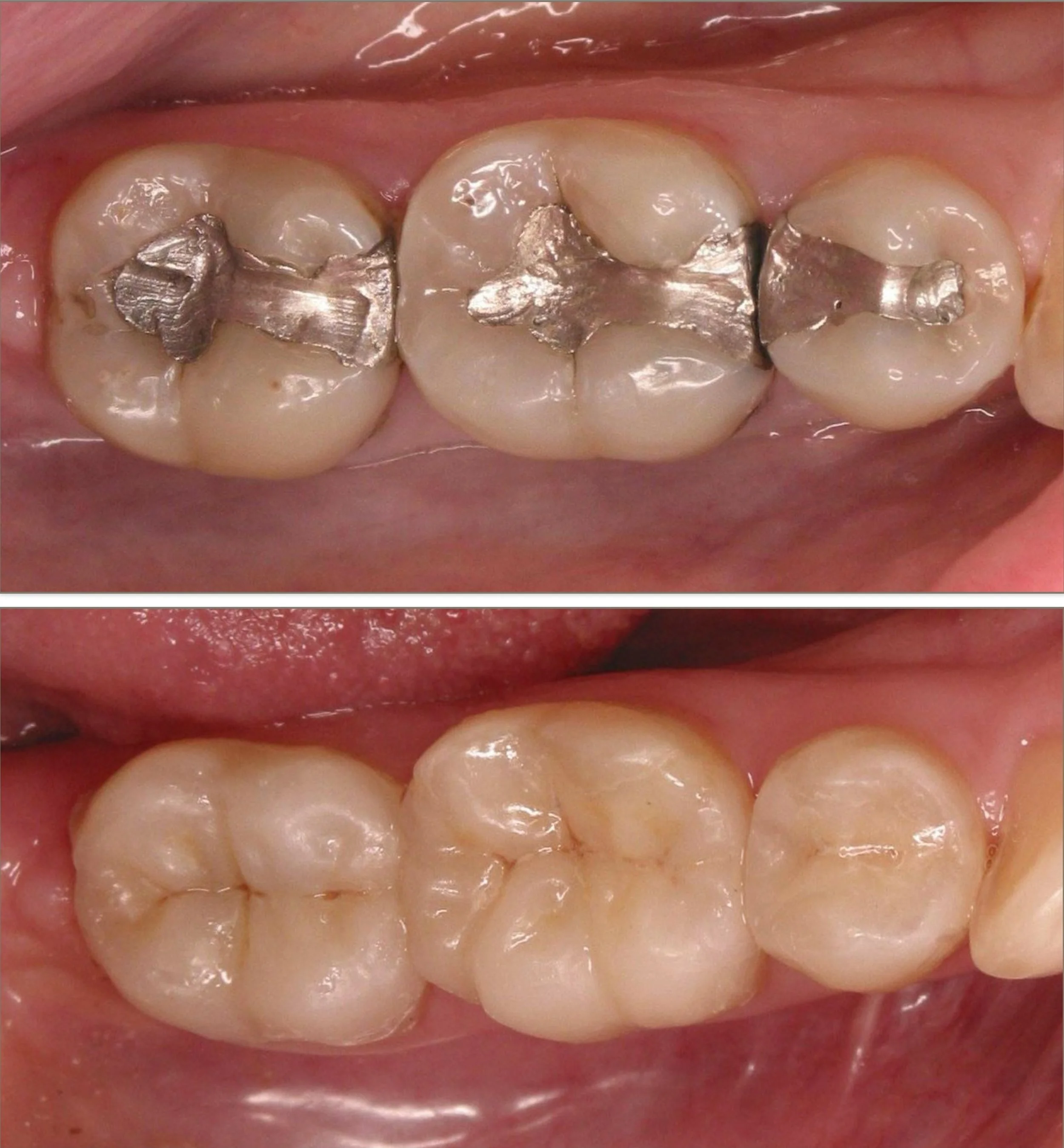 Cosmetic dentistry -  porcelain inlays at ORA in Chicago