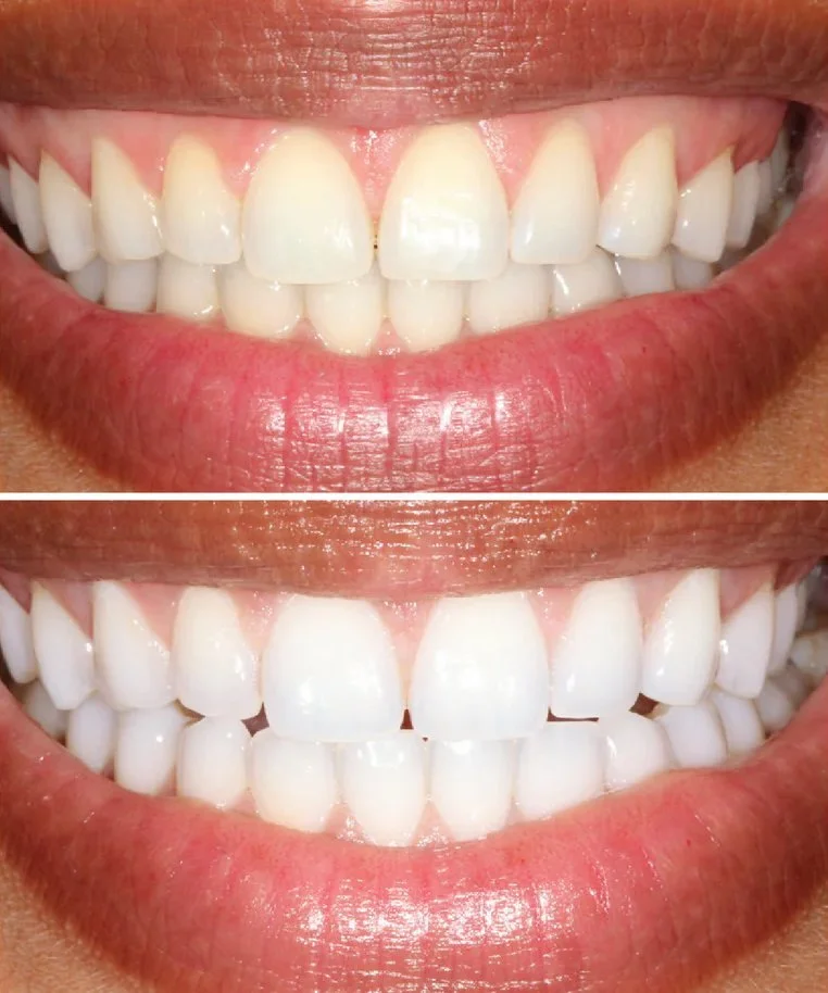 Cosmetic dentistry - Teeth Whitening at ORA in Chicago