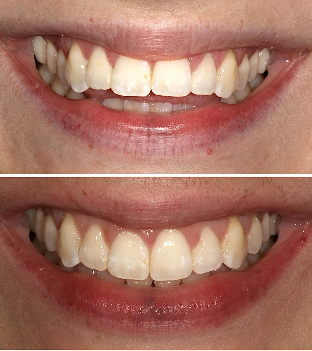 Cosmetic dentistry - Invisalign at ORA in Chicago