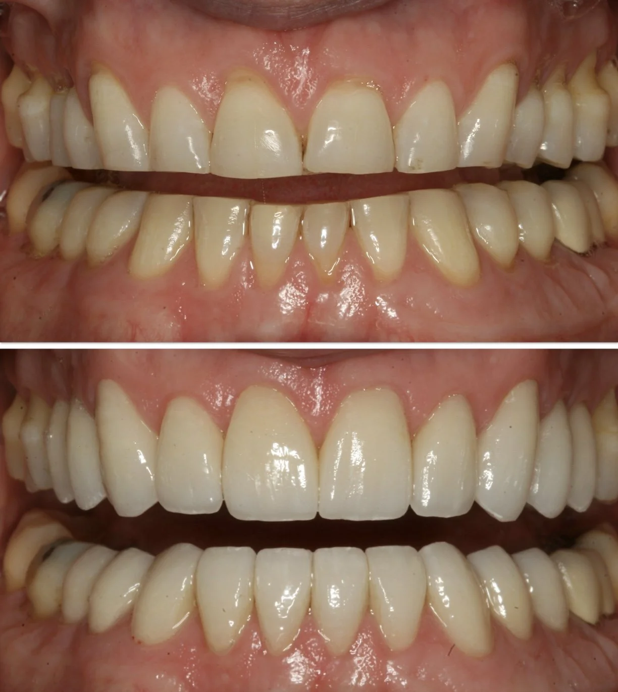 Cosmetic dentistry - Porcelain Veneers at ORA in Chicago