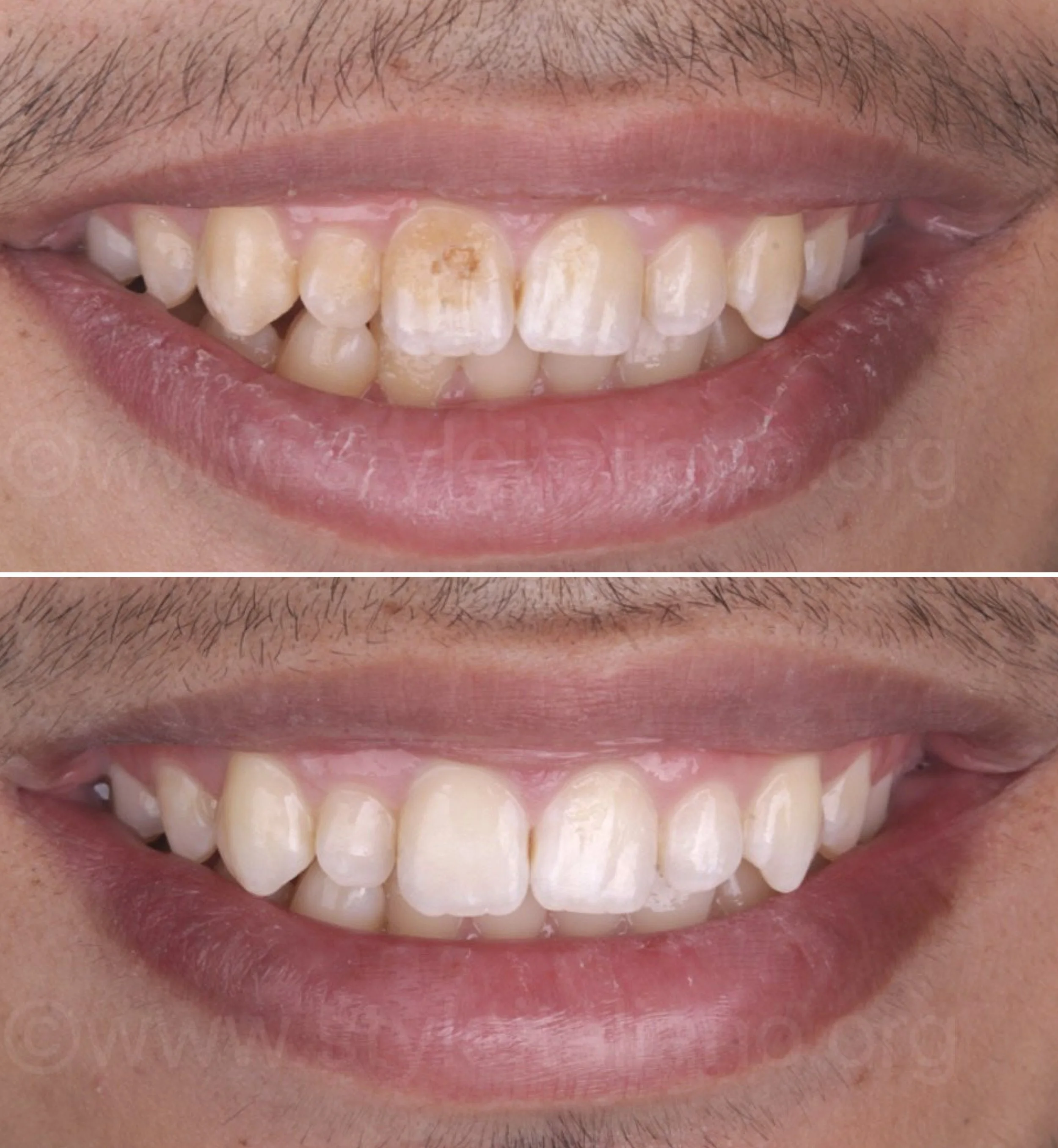 Cosmetic dentistry - Tooth Microabrasion at ORA in Chicago