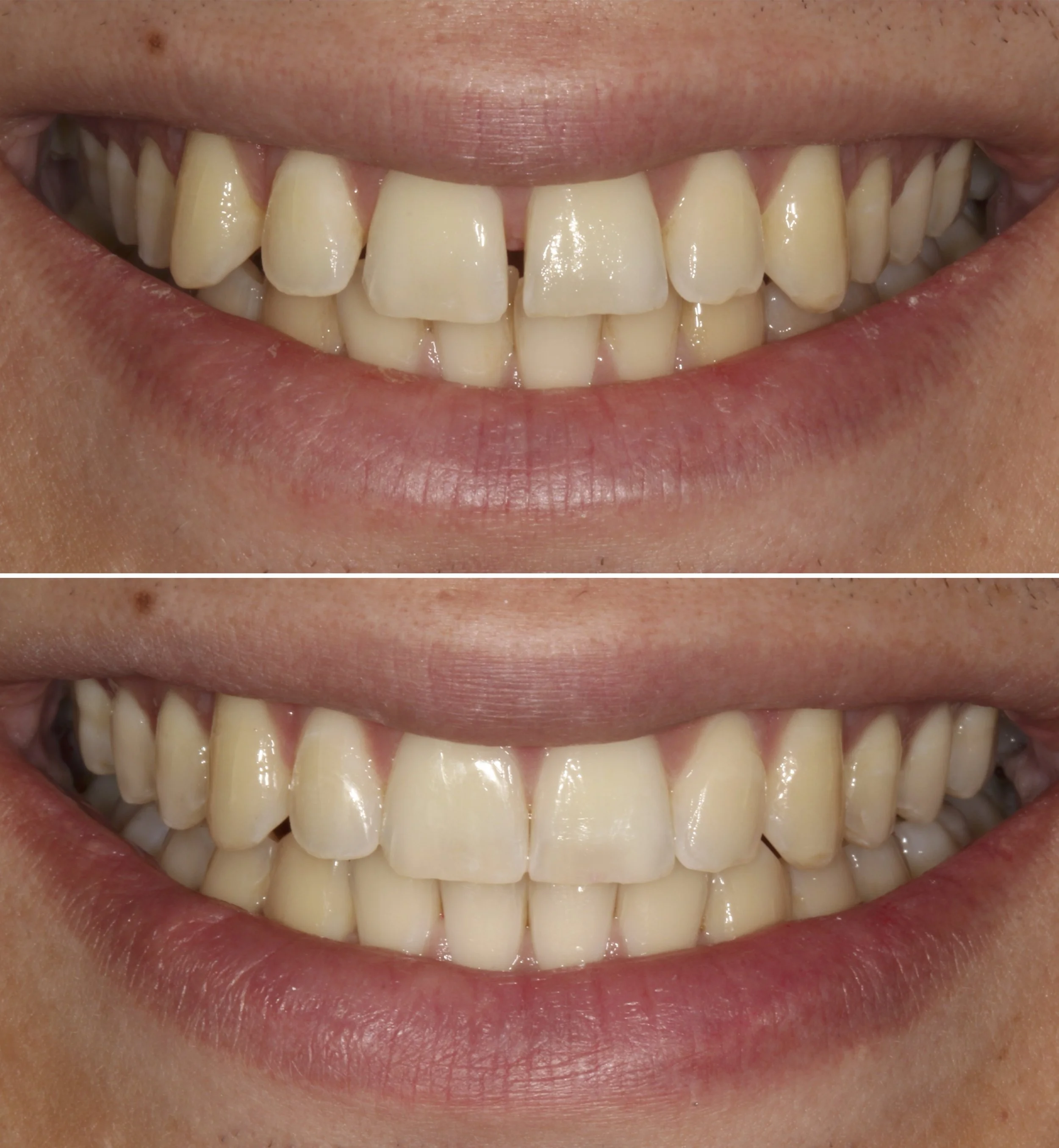 Cosmetic dentistry - Invisalign at ORA in Chicago