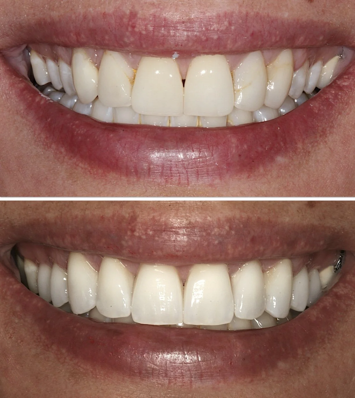 Cosmetic dentistry - Porcelain Veneers at ORA in Chicago