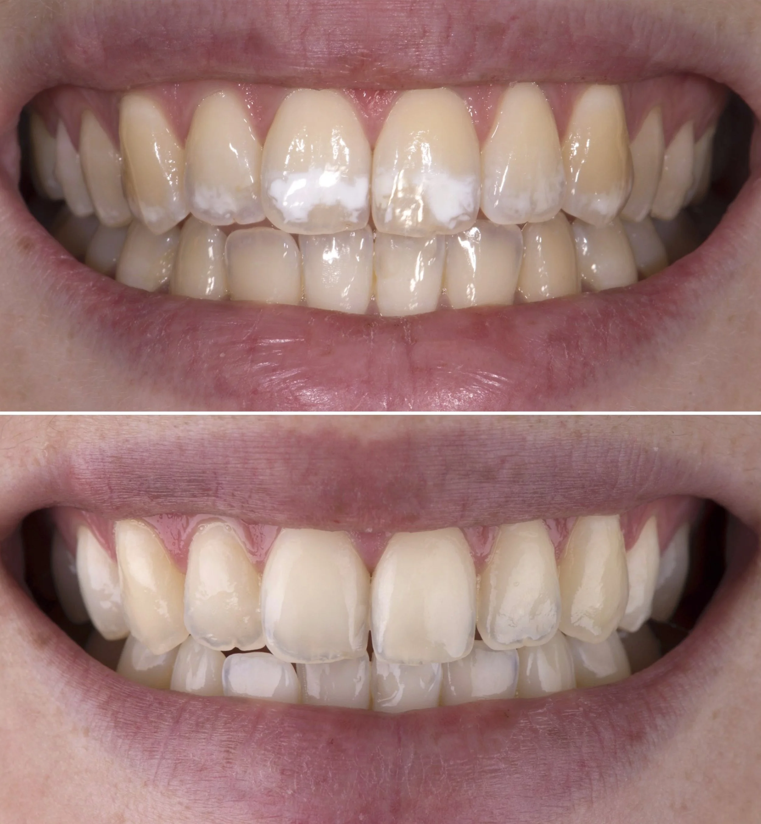Cosmetic dentistry - White spot removal at ORA in Chicago