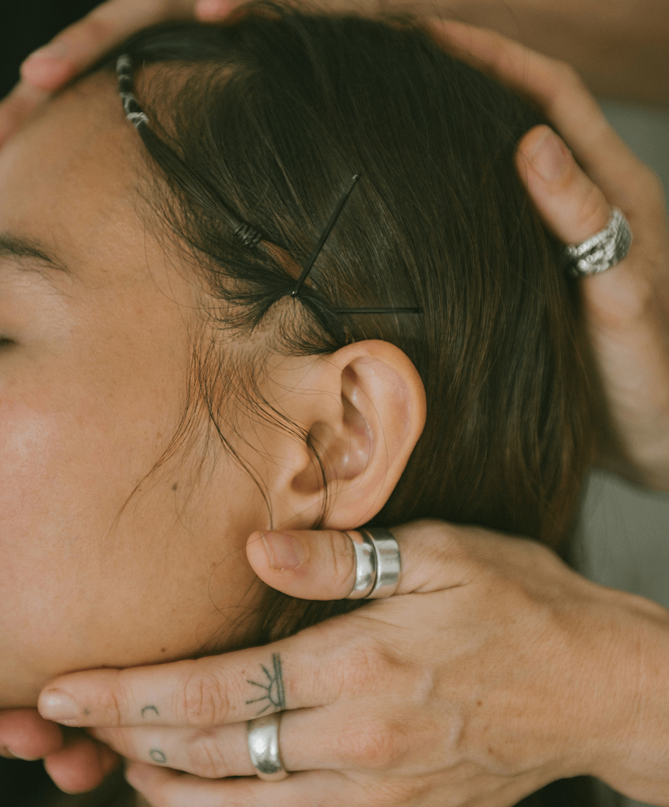 Person receiving acupuncture treatment, with several acupuncture needles inserted into their head near the temple area.