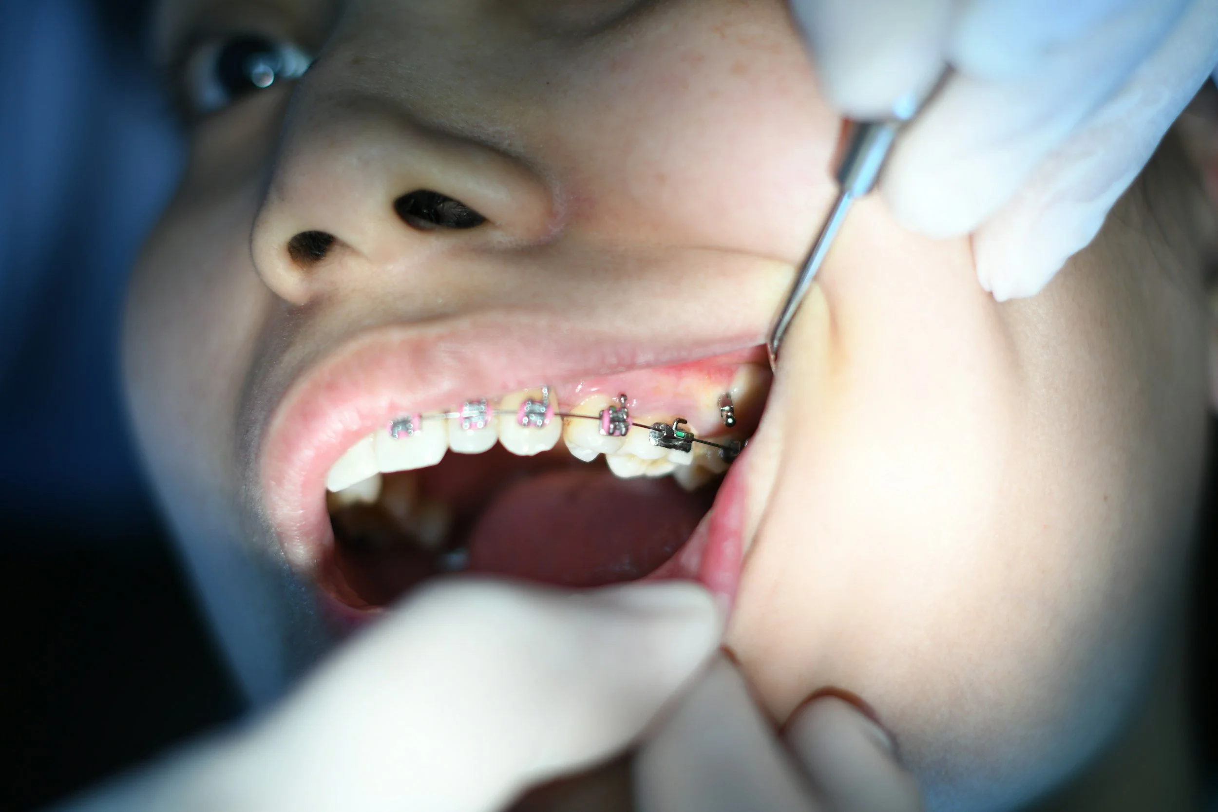 Close-up of a person with braces getting a dental check-up from a dentist wearing gloves with a dental mirror in their mouth.