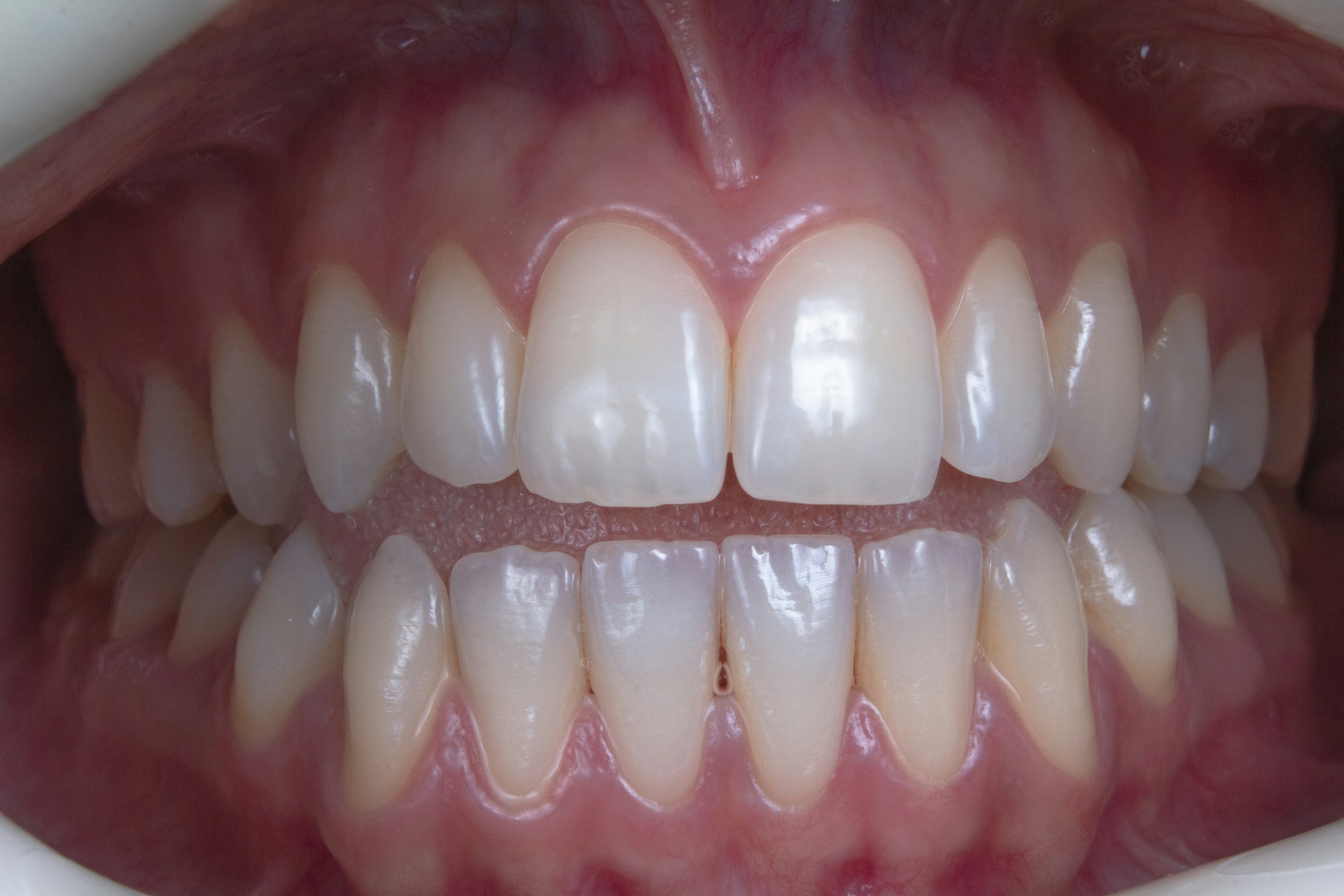 Close-up of an open mouth showing upper and lower front teeth with gums and tongue visible.