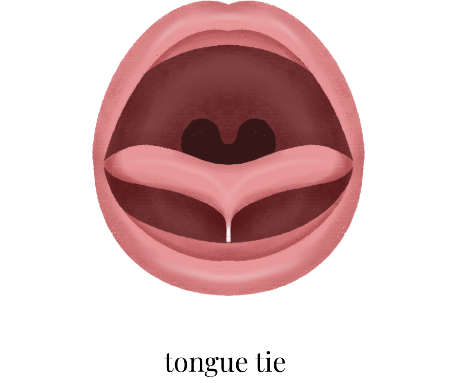 Illustration of an open mouth with a tongue tie, showing the underside of the tongue connected to the floor of the mouth. Text below reads "tongue tie."