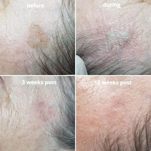 Before and After Lamprobe Skin Lesion Reduction Services in Apache Junction, AZ.