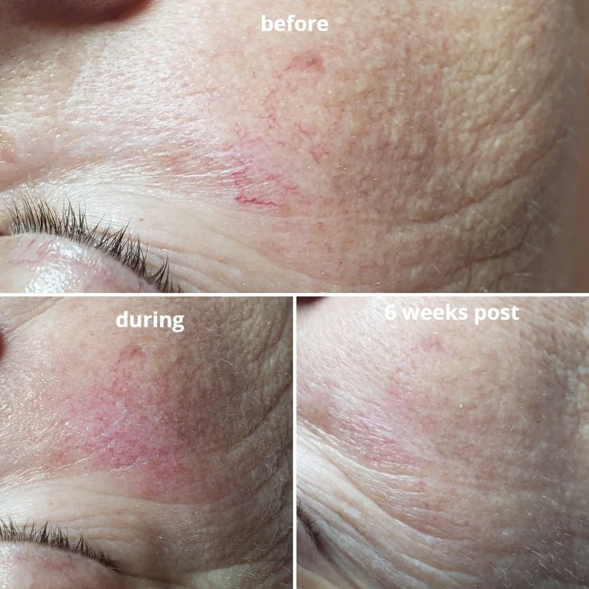 Before and After Lamprobe Skin Lesion Reduction Services in Apache Junction, AZ.