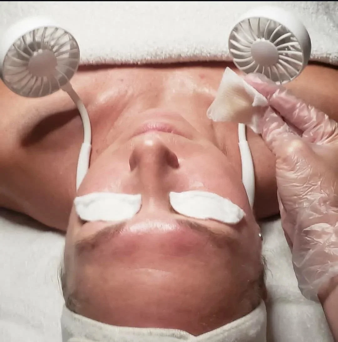 Customized chemical peels in Apache Junction, AZ.