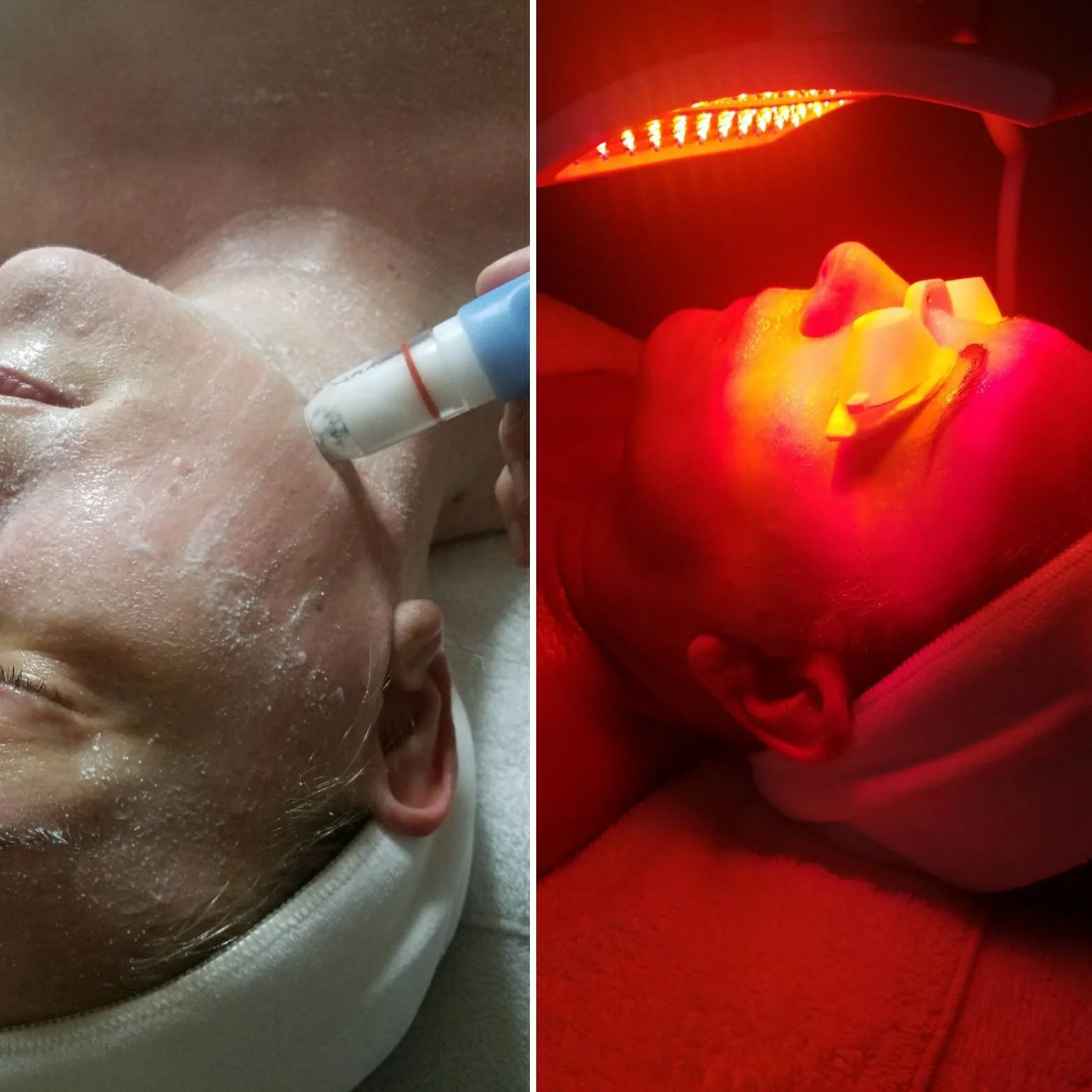 Microdermabrasion and red-light therapy in Apache Junction, AZ.