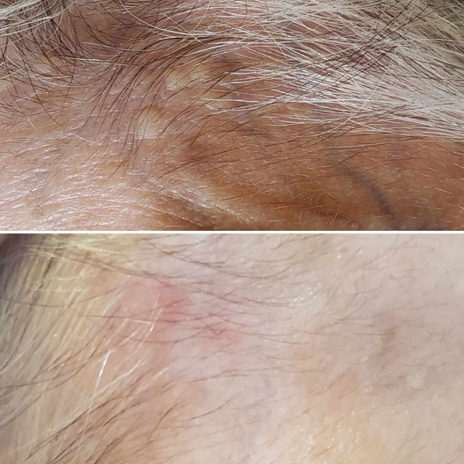 Before and After Lamprobe Skin Lesion Reduction Services in Apache Junction, AZ.