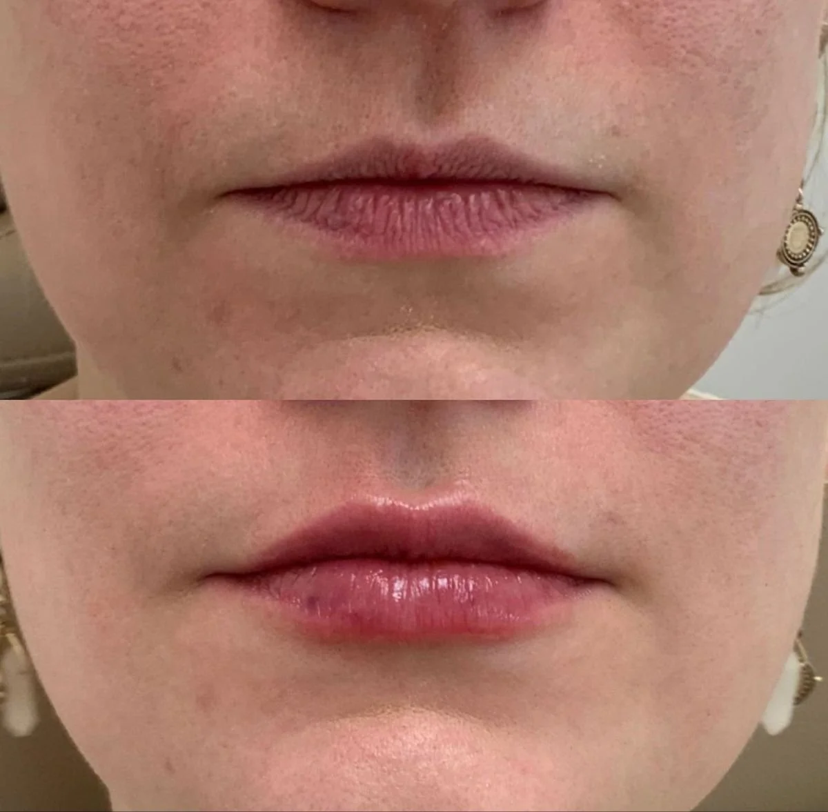 Comparison of lips before and after cosmetic enhancement, showing increased fullness and shine in the after image.