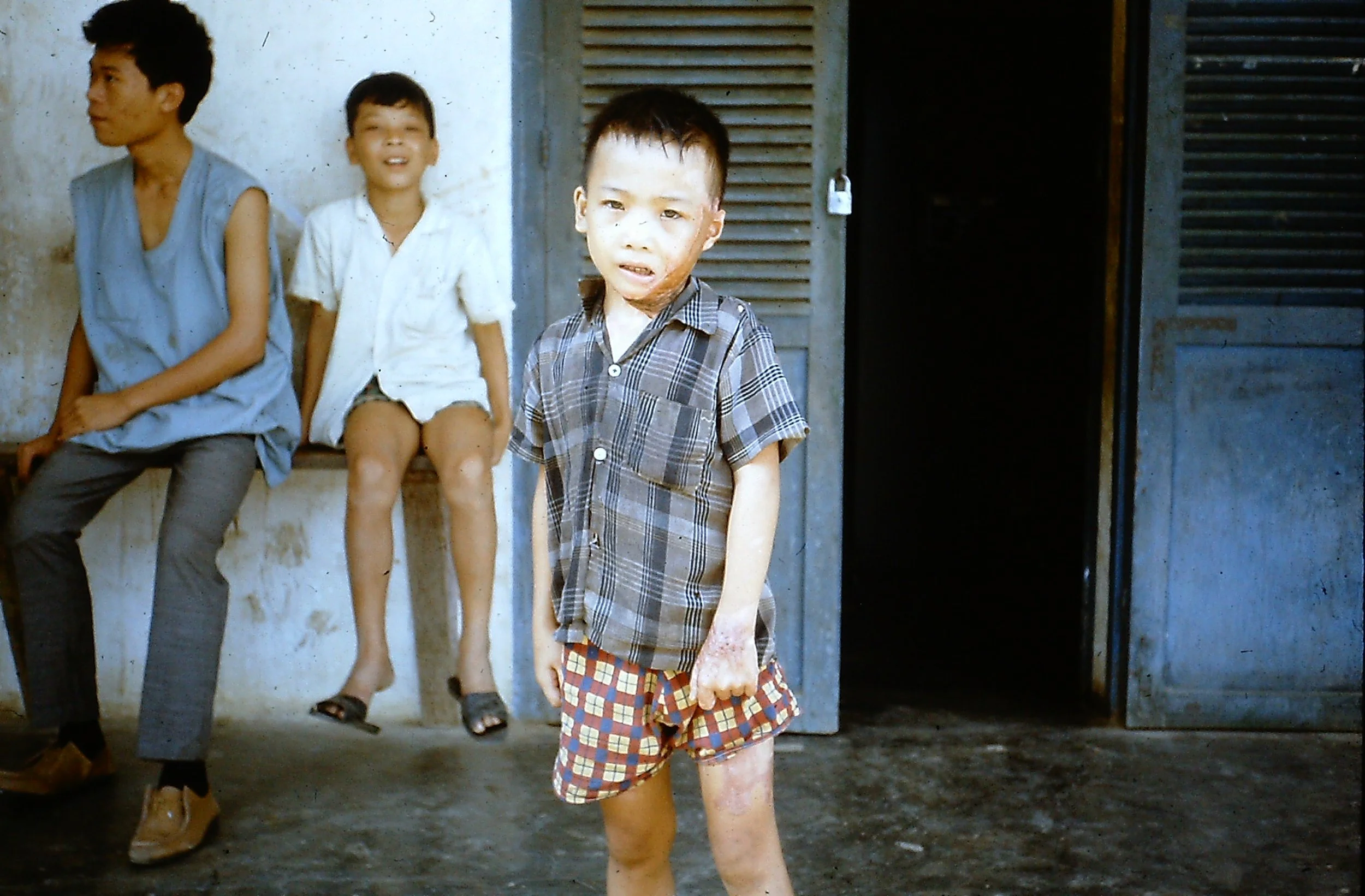 Napalm victim patient at AFSC rehabilitation center in Quảng Ngãi
