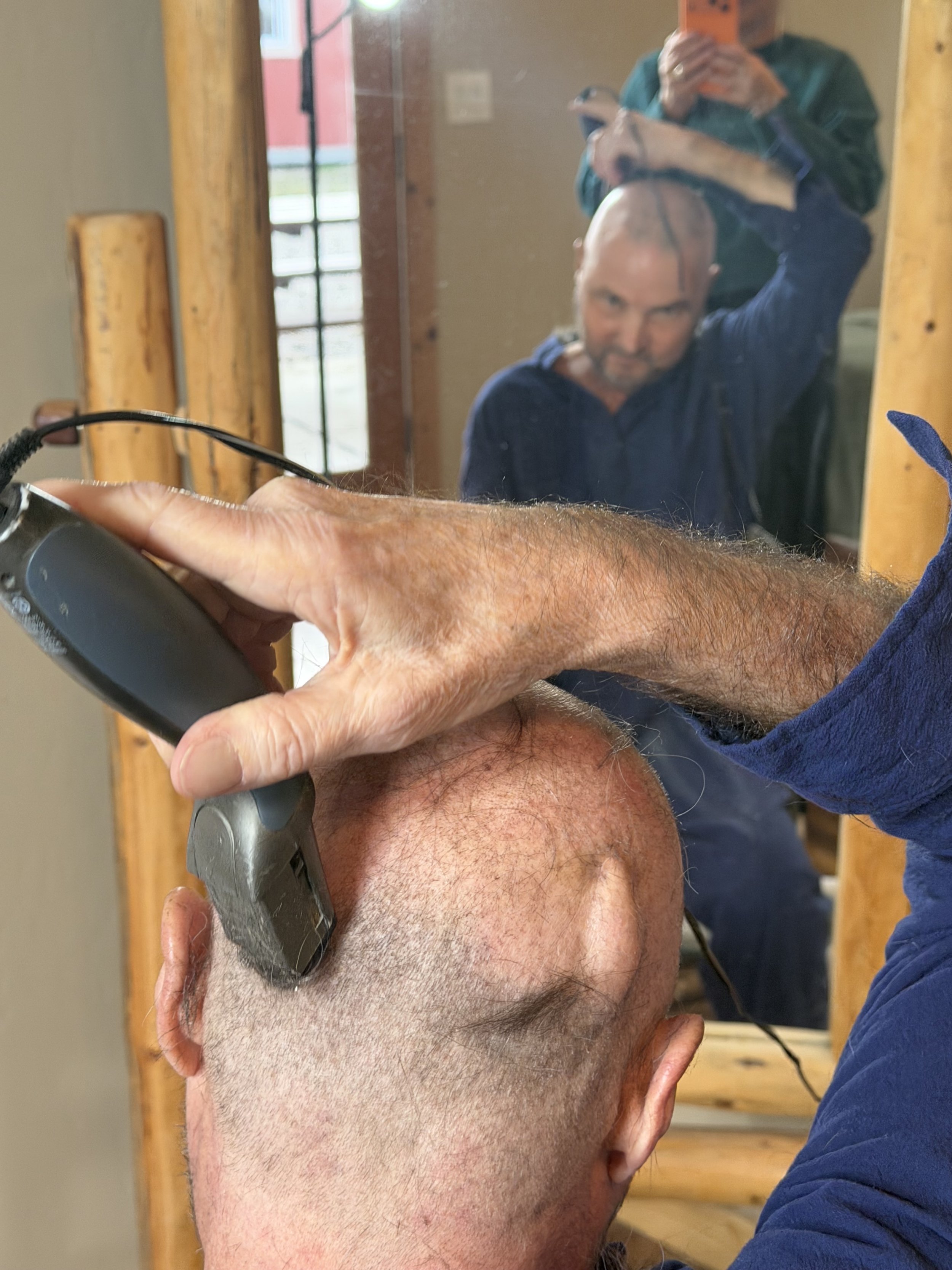 Almost done. ( the bump on the right is the permanent shunt in his brain)