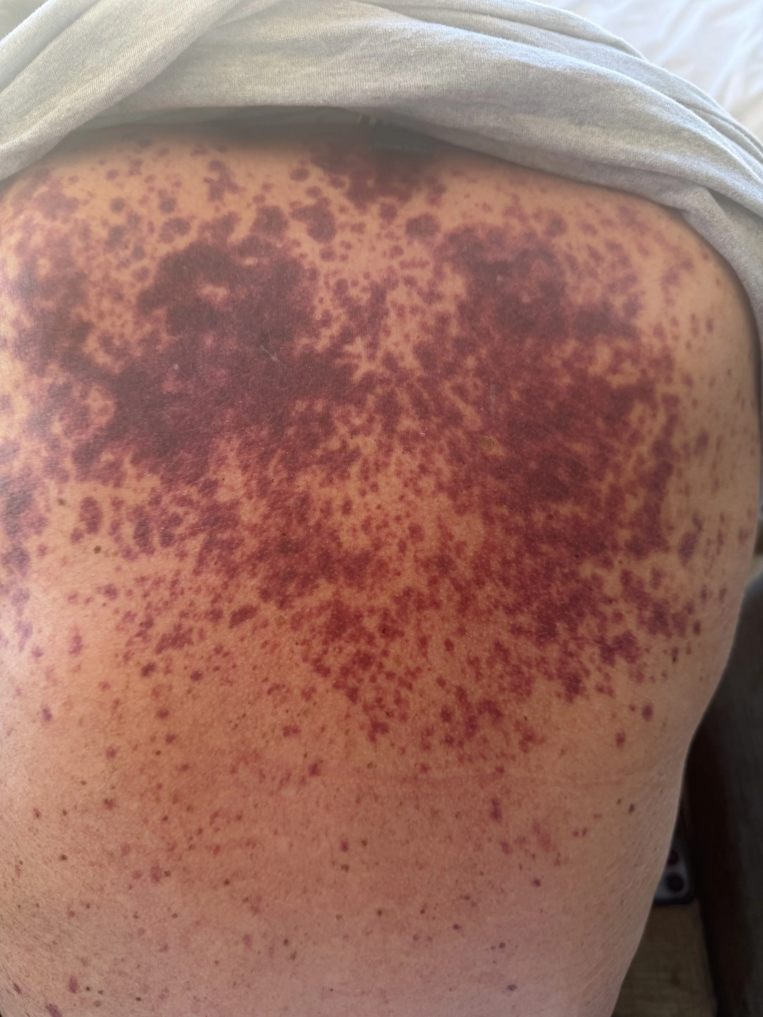Image of his back, post chemotherapy and Avastin infusions- Large patchy bruising (purpua). All over his body. 