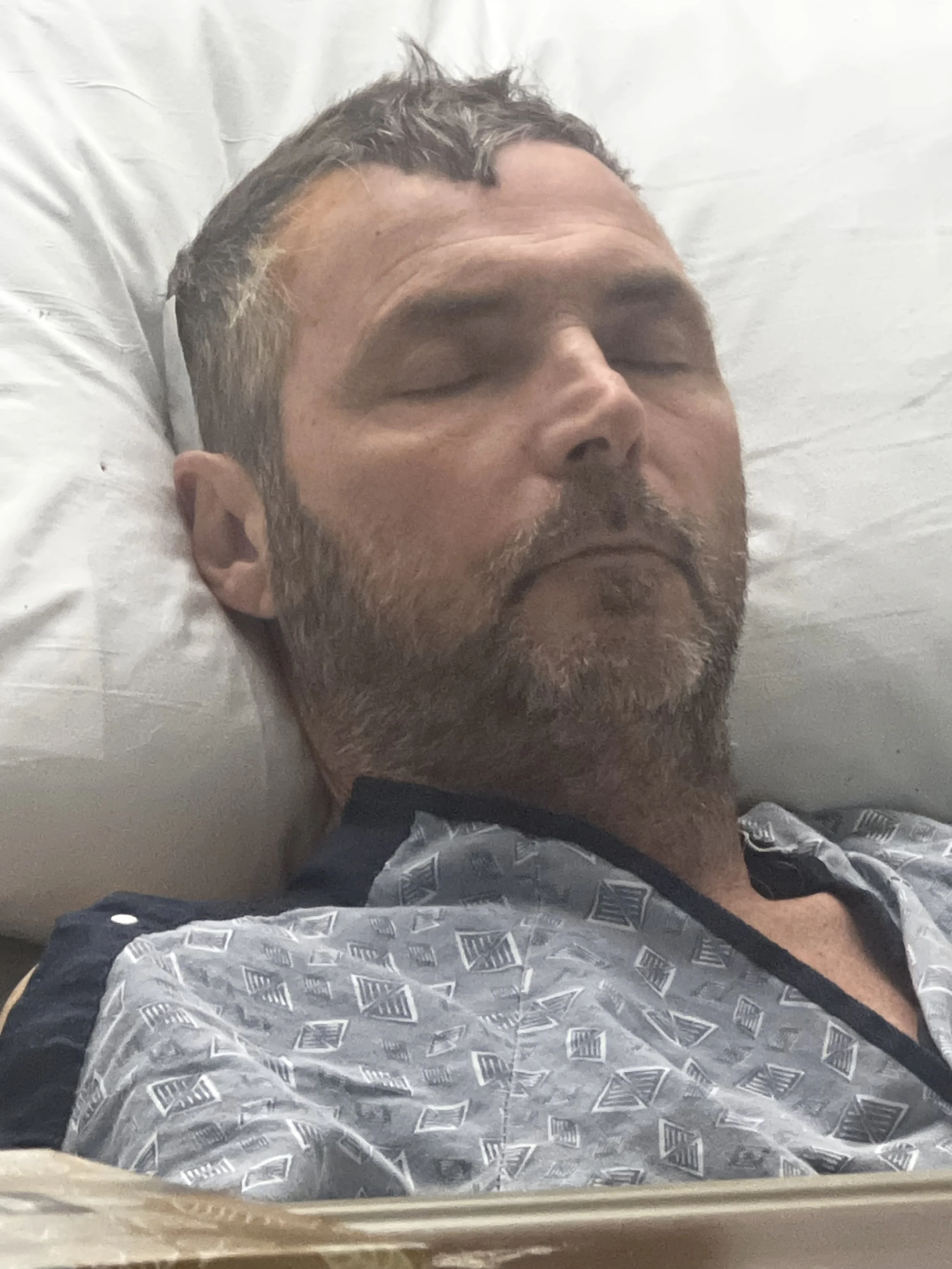 Another Surgery- shunt placed in brain to reduce fluid/hydrocephalus 