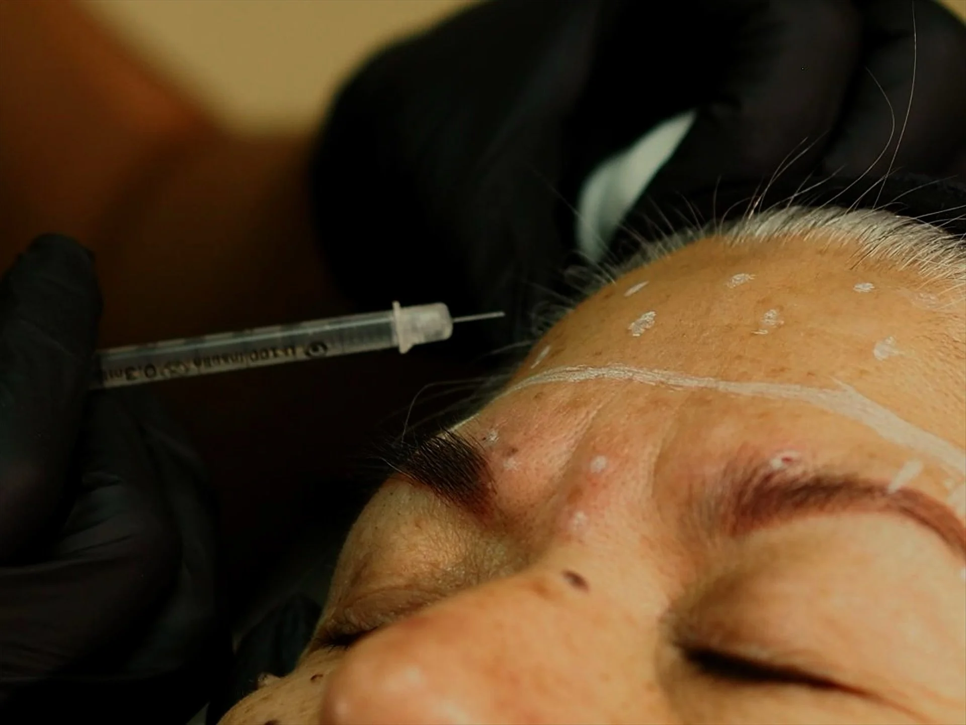 A person receiving a cosmetic injection in their forehead, with dots marked on the skin for treatment.