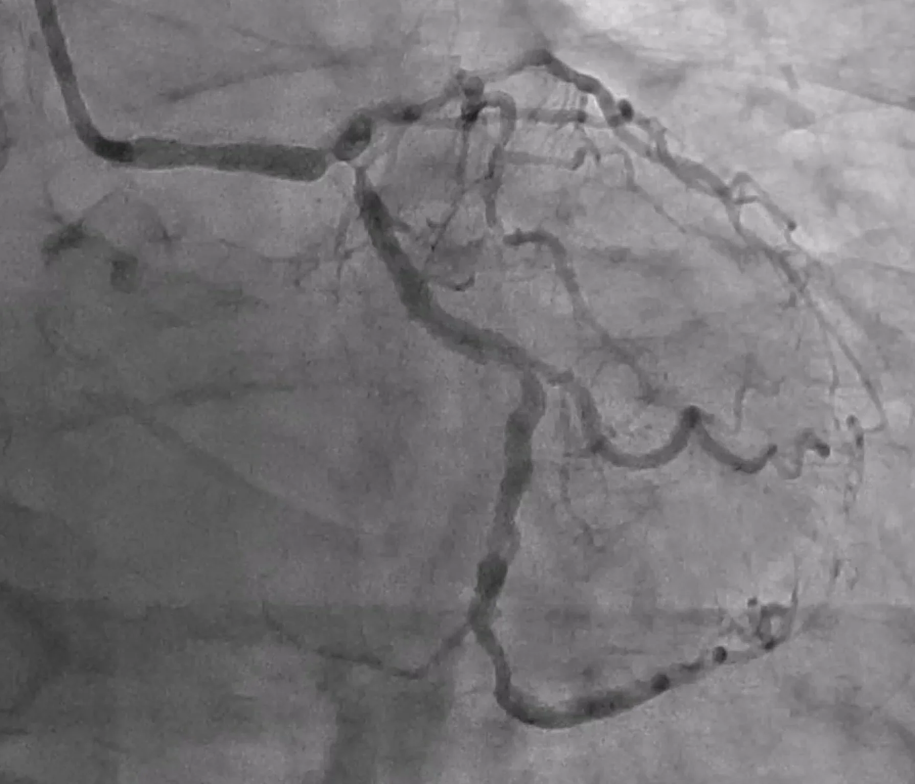 A grayscale X-ray image of a human skull showing the blood vessels of the brain.