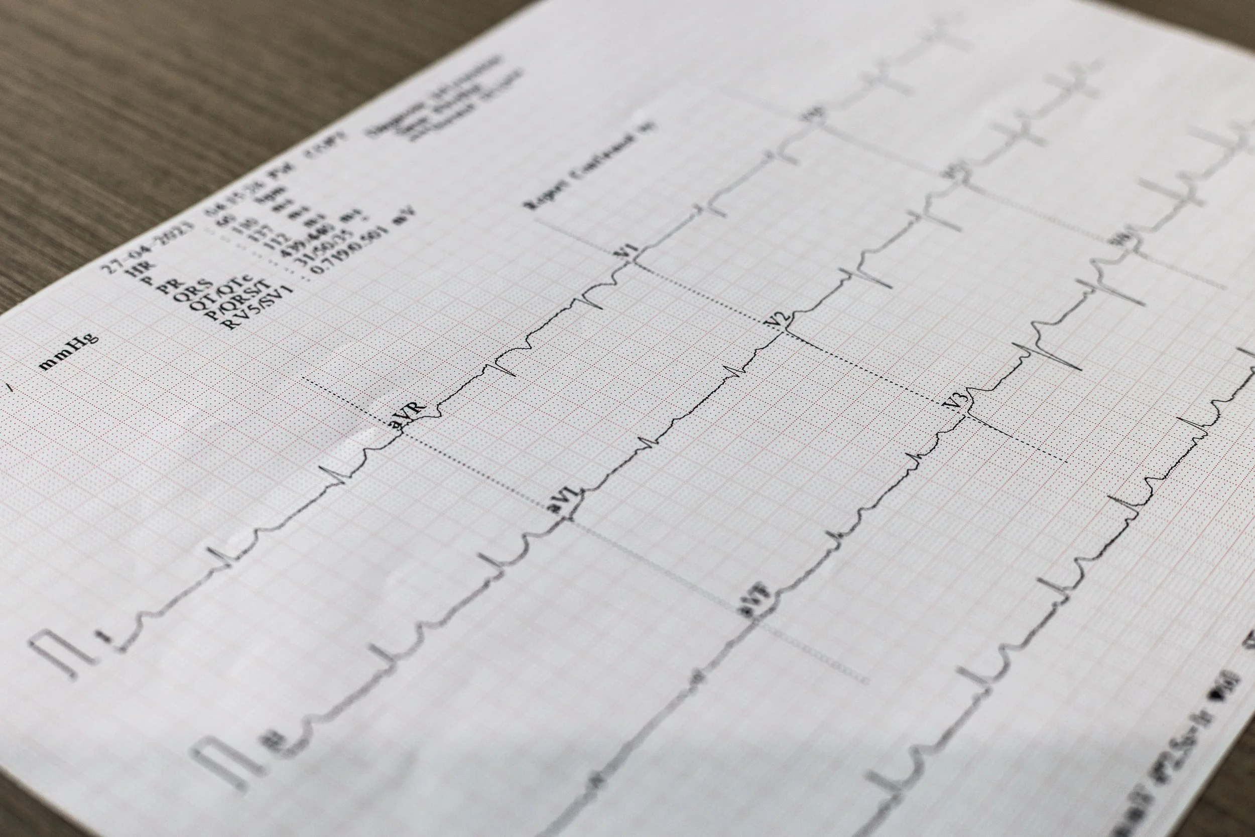 An electrocardiogram (ECG) printout showing heart activity on graph paper with various labeled sections.