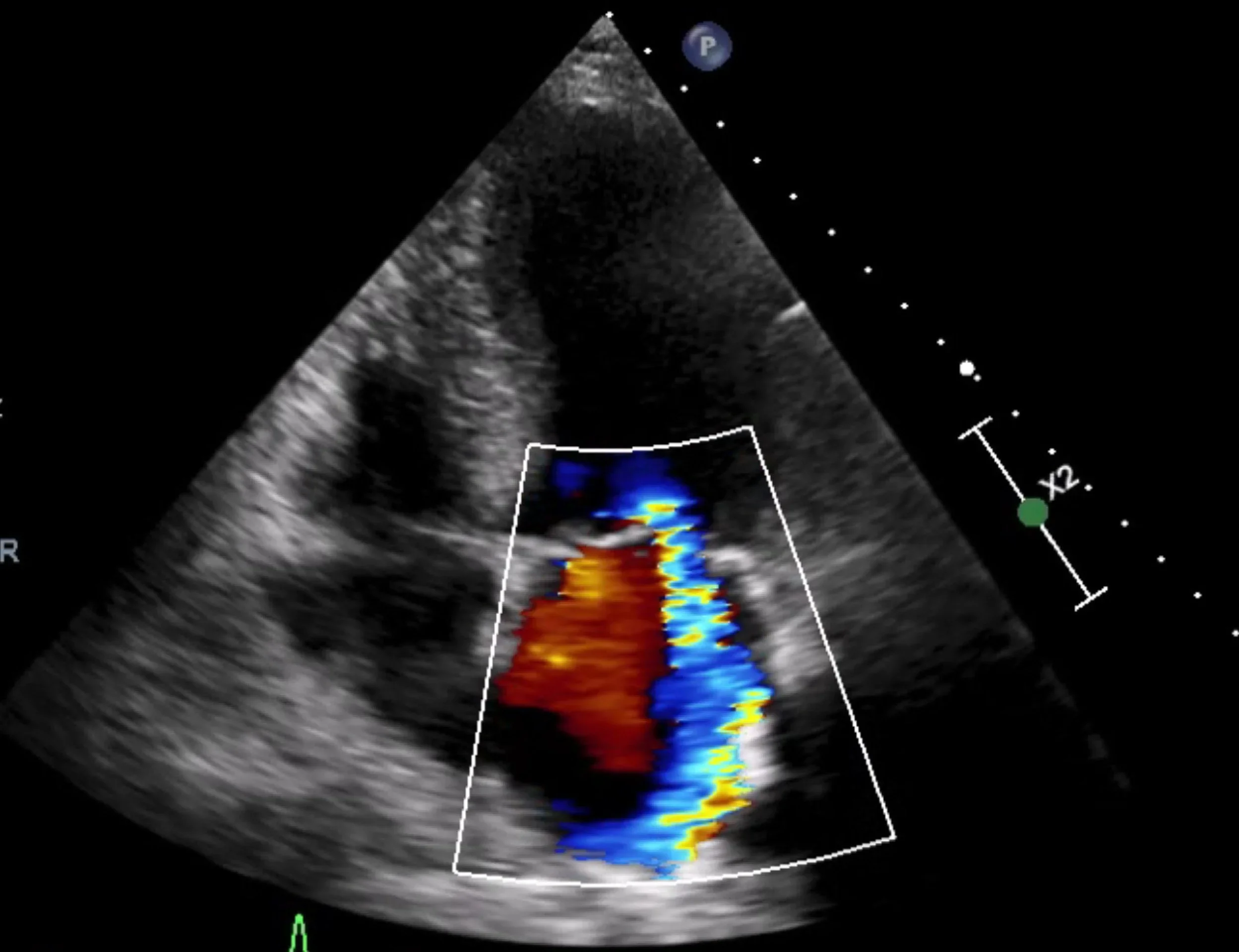 Ultrasound image of a heart showing color Doppler flow including red and blue signals indicating blood flow direction and velocity.