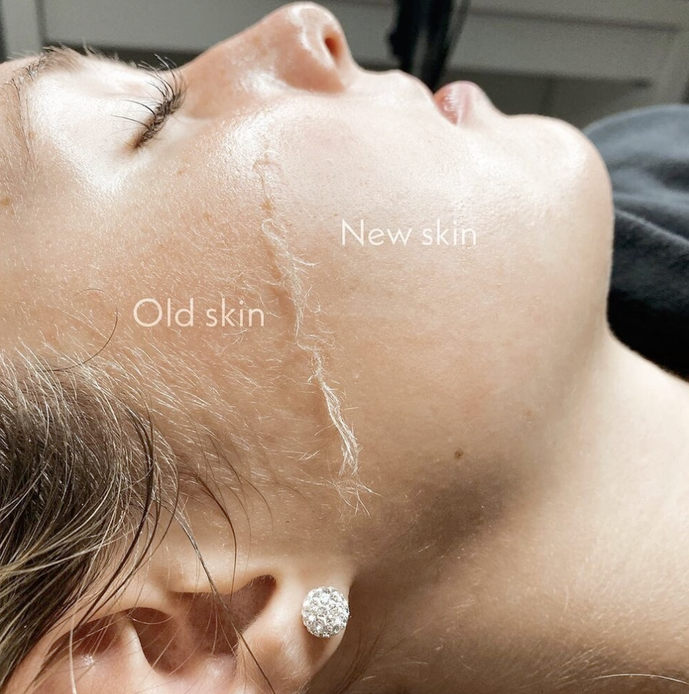 Close-up of a woman’s face showing a comparison of old and new skin, with labels indicating where the old skin is and where the new skin has formed after a skin treatment.