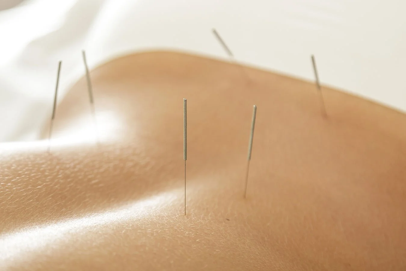 Close-up of a person's back with acupuncture needles inserted into the skin.