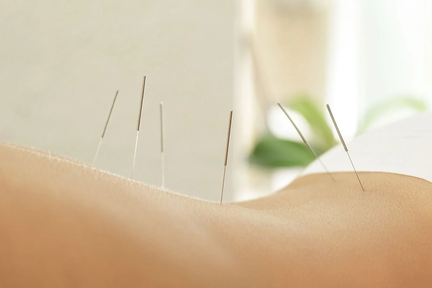 Close-up of acupuncture needles inserted into the skin of a person's back during an acupuncture treatment.