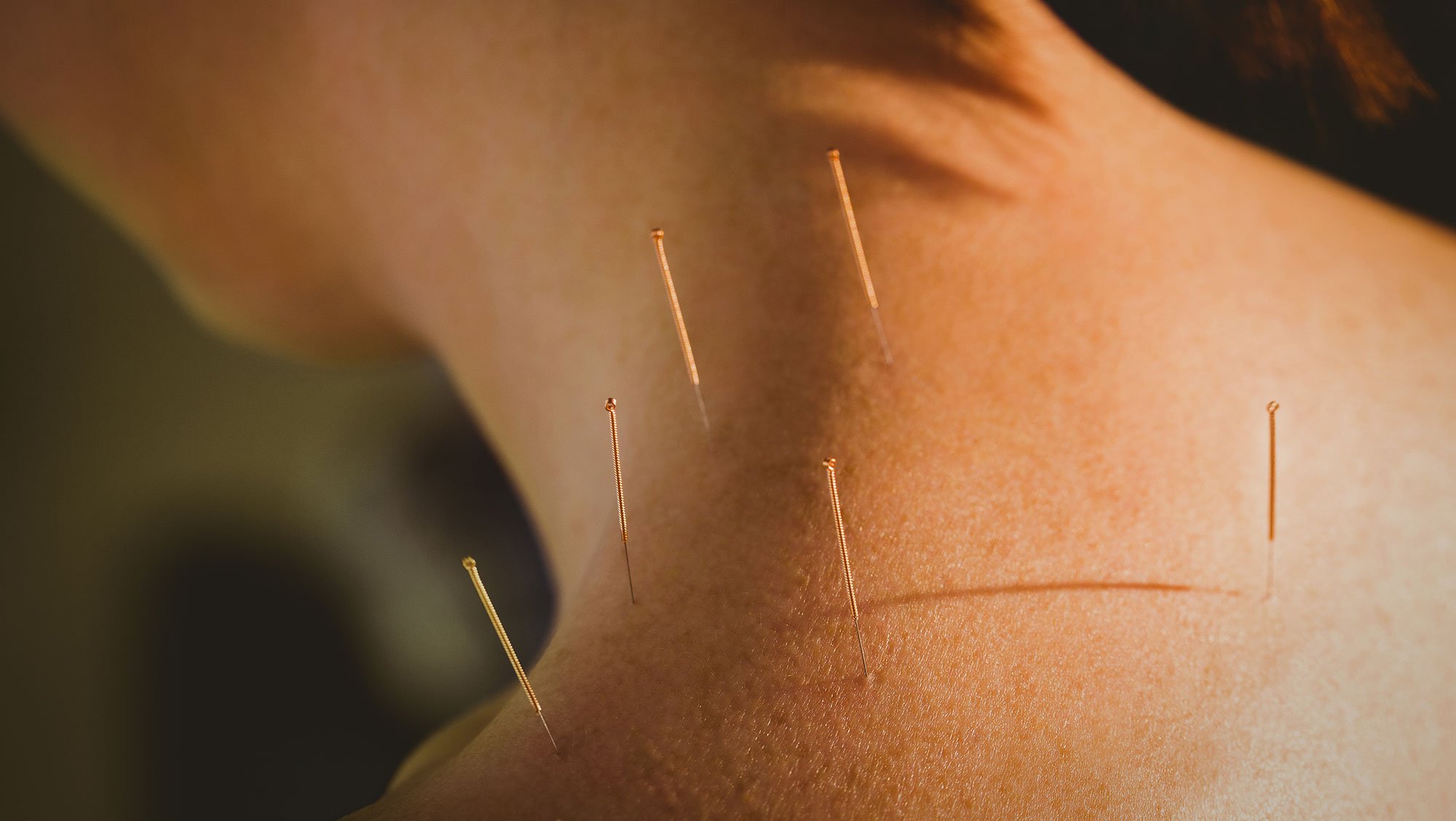 Close-up of a person's back receiving acupuncture treatment with multiple thin, metallic needles inserted into the skin.