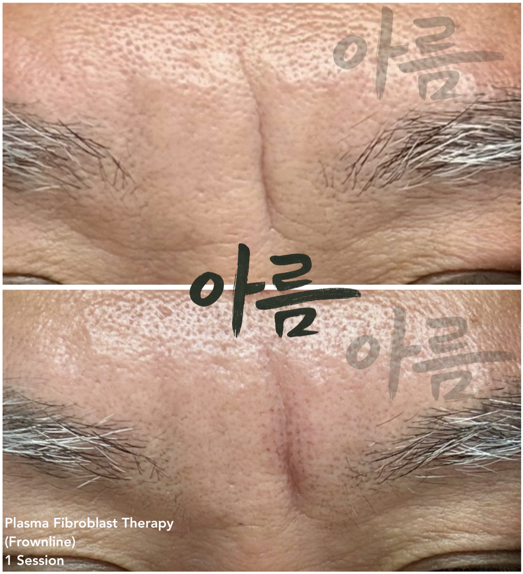Frownlines P.L..png