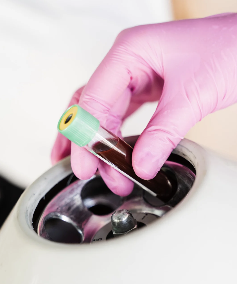 +PRF (Platelet-Rich-Fibrin)