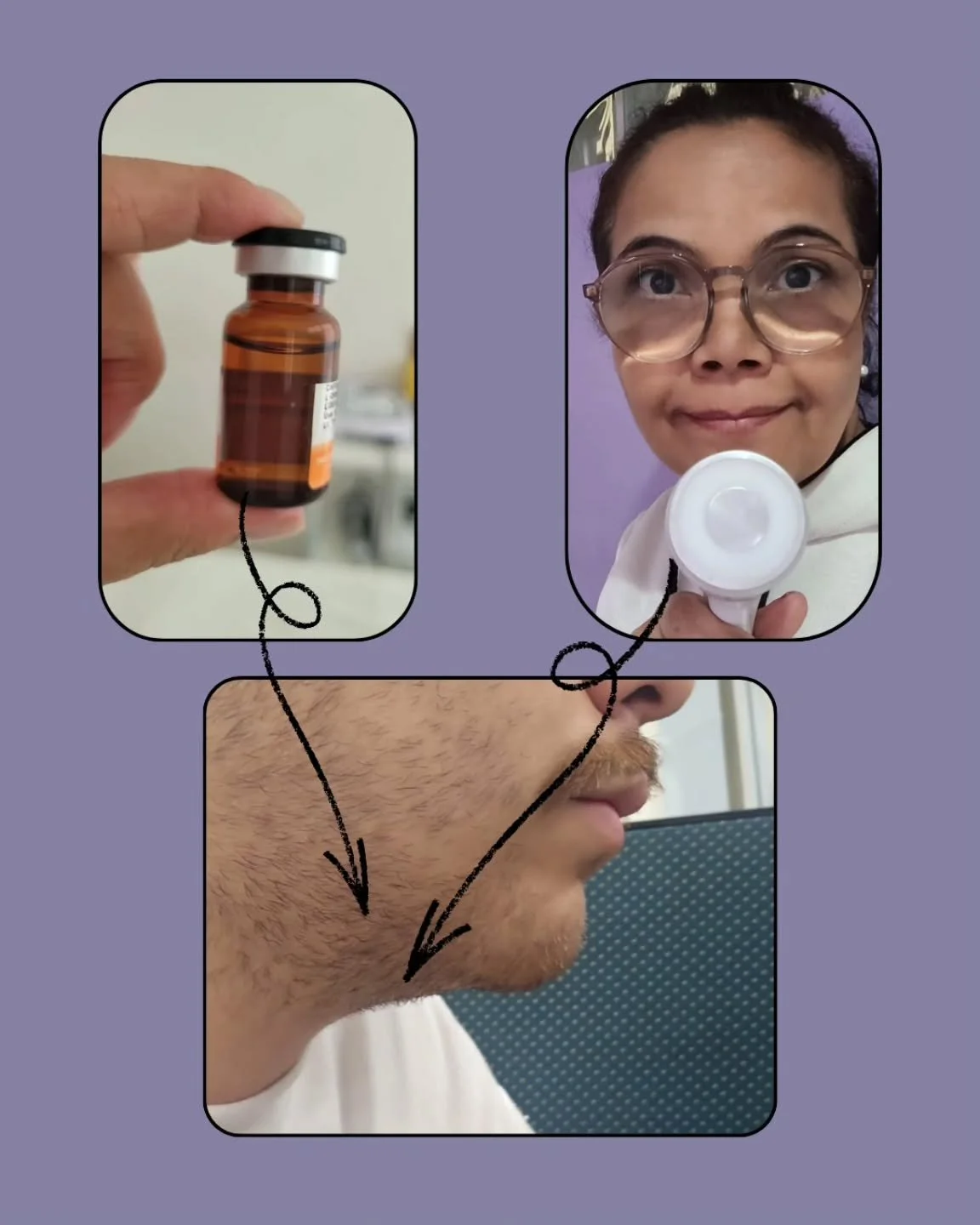 Lipo enzimatica de papada  sem invas&atilde;o