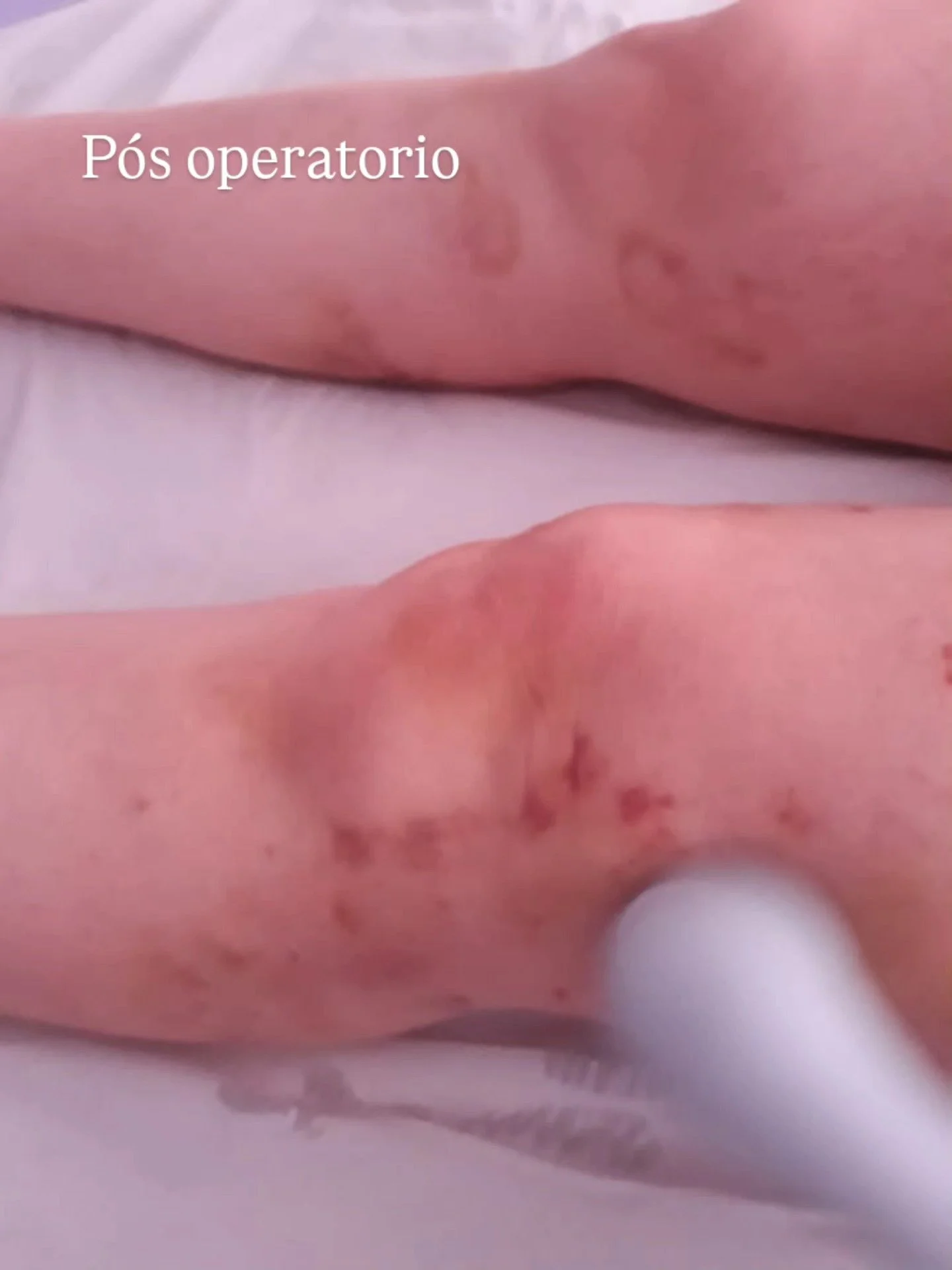 #posoperatorio I #drenagemlinfatica I