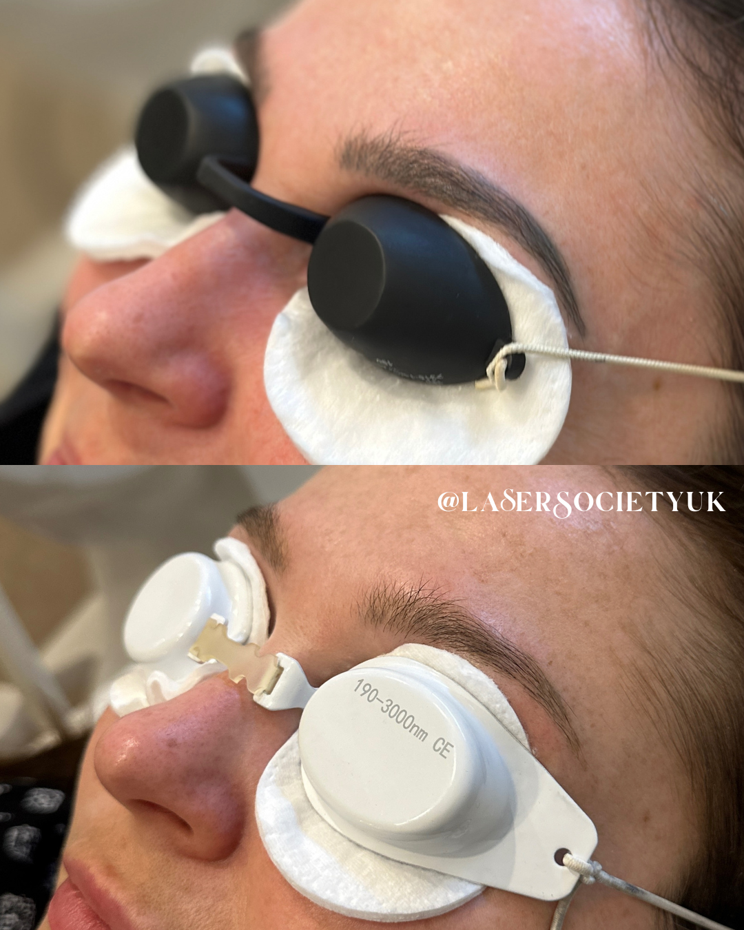 Close-up of a woman receiving removal of old semi permanent makeup removal treatment with protective eye shields in an spa or dermatology clinic.